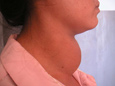 Neck Mass